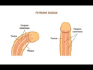 https://image.noelshack.com/fichiers/2024/27/3/1719992923-peyronie-disease-vector-illustration-600nw-360675521.jpg