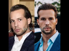 https://www.noelshack.com/2024-27-7-1720329855-tristan-tate-hair-before-hair-transplant-1024x1024.jpeg