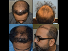 https://www.noelshack.com/2024-29-2-1721158668-hair-transplant-gone-bad.jpg