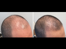 https://www.noelshack.com/2024-42-1-1728942531-finasteride-and-minoxidil-before-and-after-photos-2-yr.jpeg