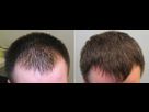 https://www.noelshack.com/2024-42-1-1728942536-finasteride-before-and-after-12-months-11.jpeg