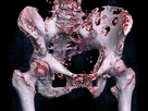 https://image.noelshack.com/fichiers/2024/43/4/1729787622-640px-3d-rendered-ct-of-hip-bone-metastases.jpg