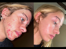 https://www.noelshack.com/2024-45-5-1731078020-acne-before-after-v0-omxk7r6xlozd1.jpg