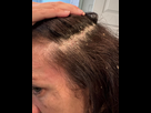 https://image.noelshack.com/fichiers/2025/03/7/1737293041-does-this-look-like-psoriasis-or-seborrheic-dermatitis-v0-4h51qzakn7wd1.jpeg