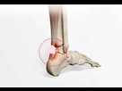 https://image.noelshack.com/fichiers/2025/05/4/1738268438-rupture-du-tendon-achille-dr-paillard-paris.jpg