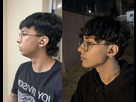 https://image.noelshack.com/fichiers/2025/07/1/1739204379-7-months-post-op-djs-genio-remov.jpg
