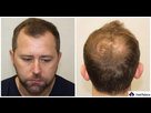https://image.noelshack.com/minis/2025/09/2/1740520788-neil-avant-sa-greffe-de-cheveux-1024x546-1.png