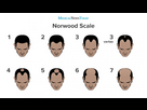 https://image.noelshack.com/fichiers/2025/14/5/1743718319-an-infographic-of-the-norwood-scale.jpg