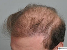 https://image.noelshack.com/fichiers/2025/16/4/1744907325-echec-de-la-greffe-de-cheveux.jpg