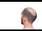 https://image.noelshack.com/fichiers/2025/16/5/1744974785-190819-img-actu-zones-du-cuir-chevelu-touch-es-par-la-calvitie-removebg-preview.png