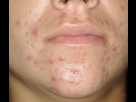 https://image.noelshack.com/fichiers/2025/19/1/1746441117-acn-inflammatoire-papule-pustule.jpg