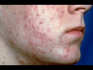 https://image.noelshack.com/fichiers/2025/19/1/1746441898-acne-severe-425311-1833642267-1.jpg