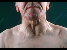 https://image.noelshack.com/fichiers/2025/24/5/1749836503-c0144419-goiter.jpg