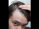 https://image.noelshack.com/fichiers/2026/01/5/1767371254-receding-or-mature-hairline-im-18-v0-w5b1nh64jurb1.png